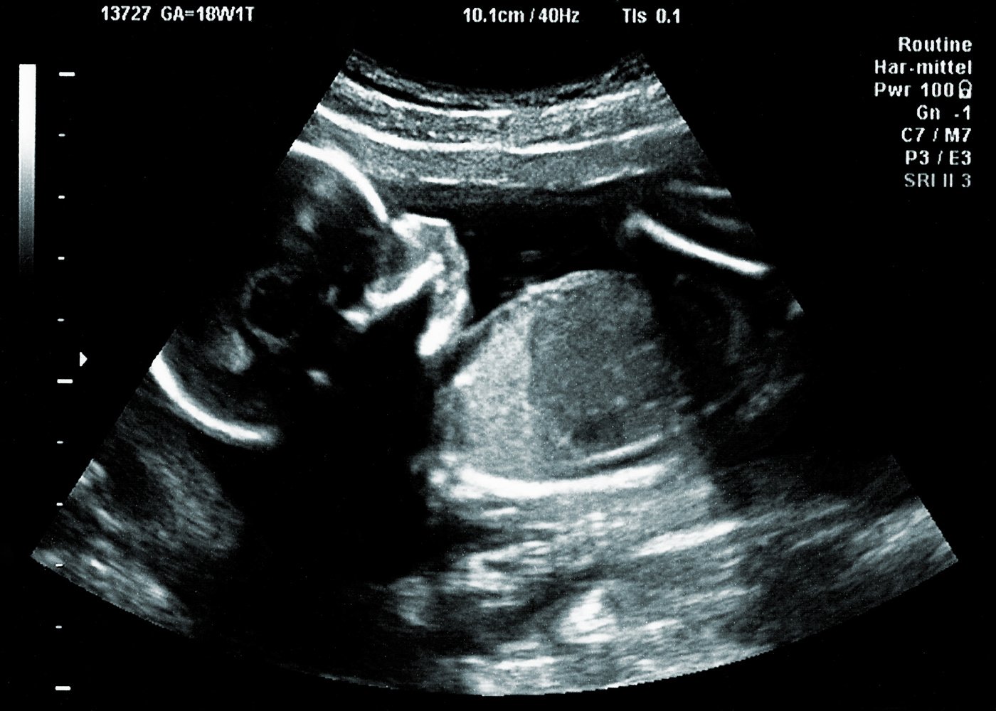 Ultrasound of Baby in a Mothers Womb
