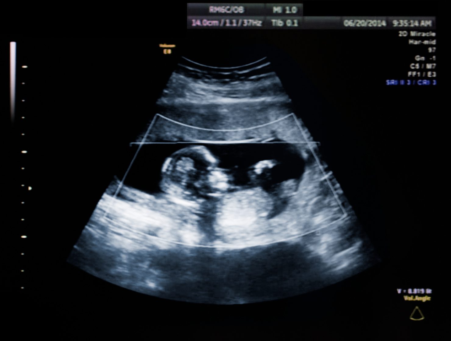 Ultrasound